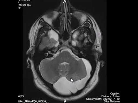 Mega cisterna magna, arachnoid cyst, and Dandy Walker variant .